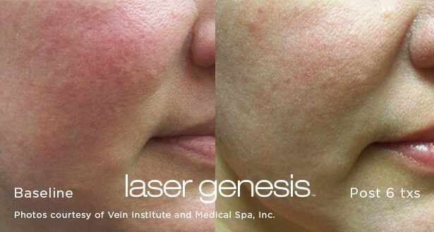 Laser Genesis Skin Care Health